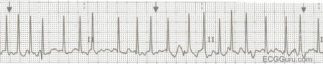 ecg-basics-atrial-fibrillation-with-rapid-ventricular-response-ecg